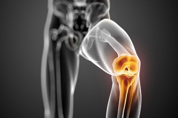 Arthrose des Kniegelenks