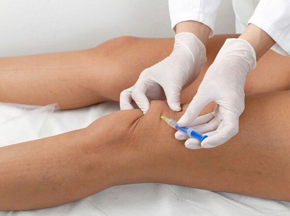 intraartikuläre Injektion bei Kniearthrose